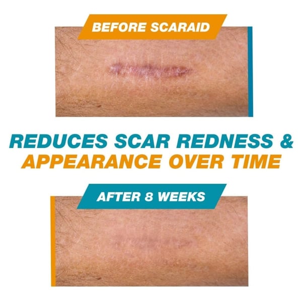 SCAR SOLUTIONS - Silicone Scar Stick - For Face and Body