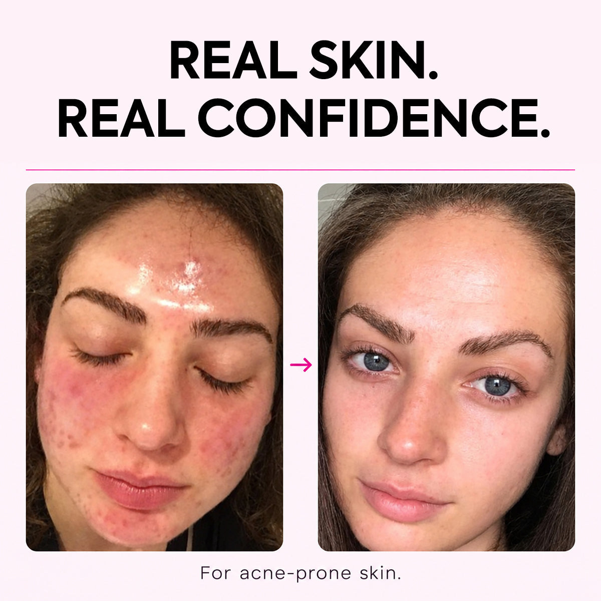 Acne Care Body Spray