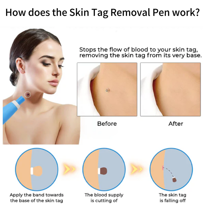 Skin Tag Removal Kit