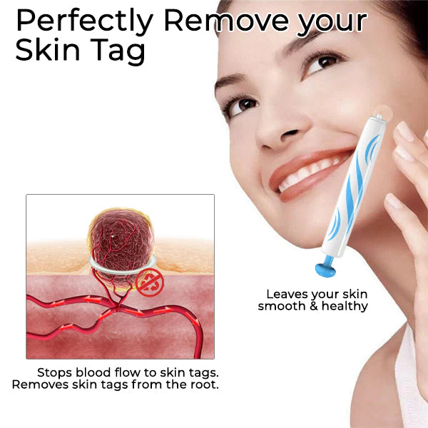 Skin Tag Removal Kit