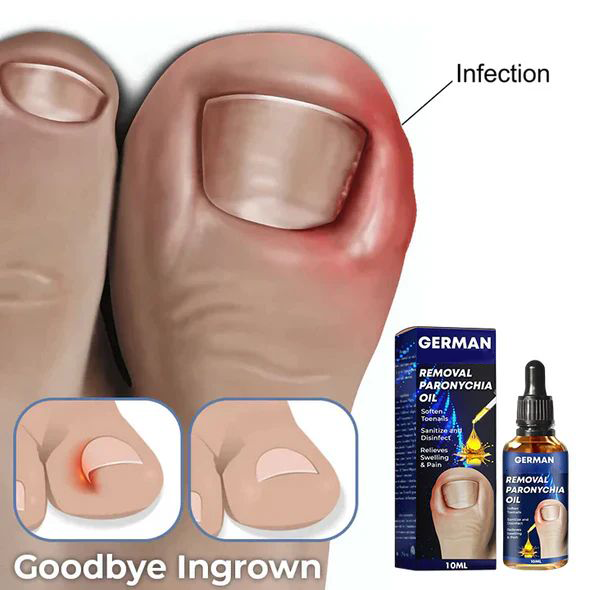 Lazzda Removal Paronychia