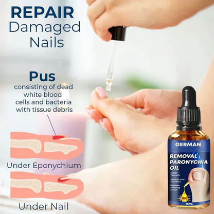 Lazzda Removal Paronychia