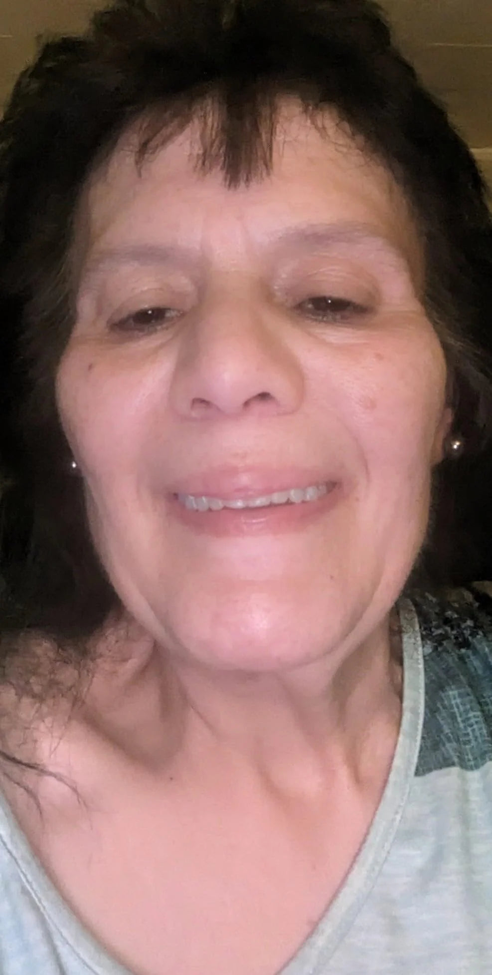 Premium Full Cover Dentures