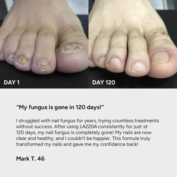 Gel de traitement contre les mycoses des ongles