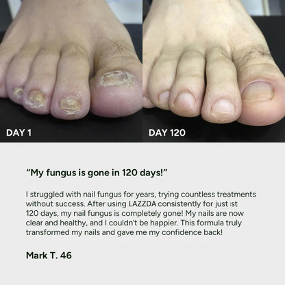 Gel de traitement contre les mycoses des ongles