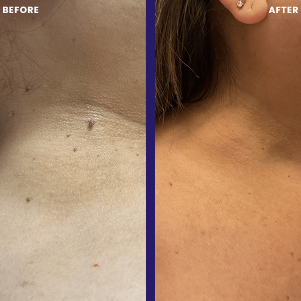 Skin Tag Removal Kit