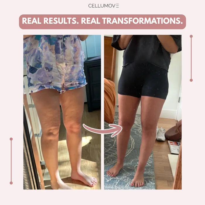 Lazzda 3D Legging – Say goodbye to lipoedema pain and swelling naturally