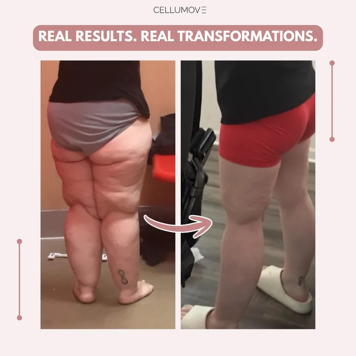Lazzda 3D Legging – Say goodbye to lipoedema pain and swelling naturally
