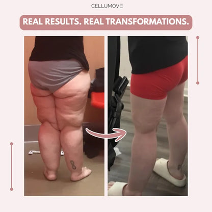 Lazzda 3D Legging – Say goodbye to lipoedema pain and swelling naturally