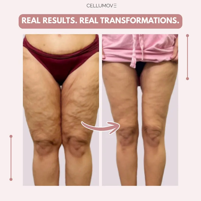 Lazzda 3D Legging – Say goodbye to lipoedema pain and swelling naturally