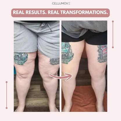 Lazzda 3D Legging – Say goodbye to lipoedema pain and swelling naturally