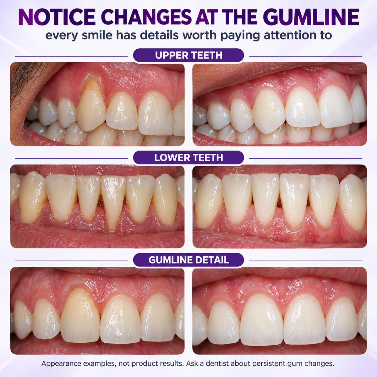 🇨🇦👨‍⚕️✅️👍Advanced Formula🦷Lazzda GumRevive Periodontal Repair Gel