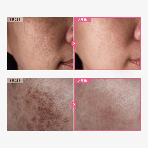 Arbutin 7% + Tranexamic Acid 4% Cream