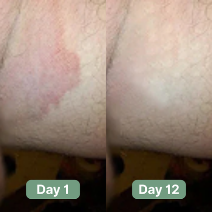 Savon antifongique d'Andrew 