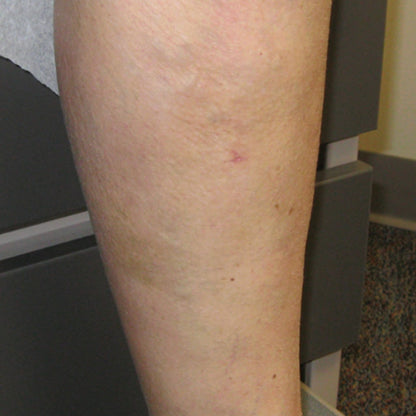 C-Varicose Vein Cream