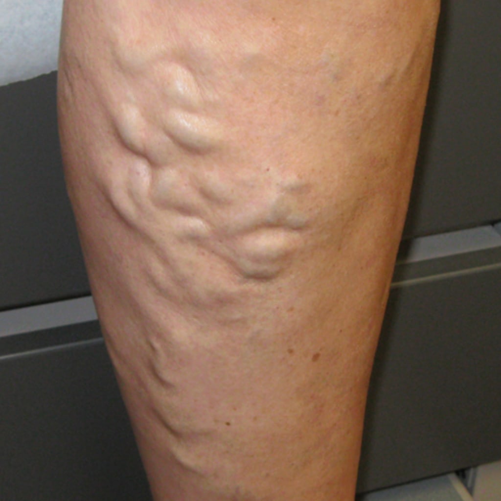 C-Varicose Vein Cream