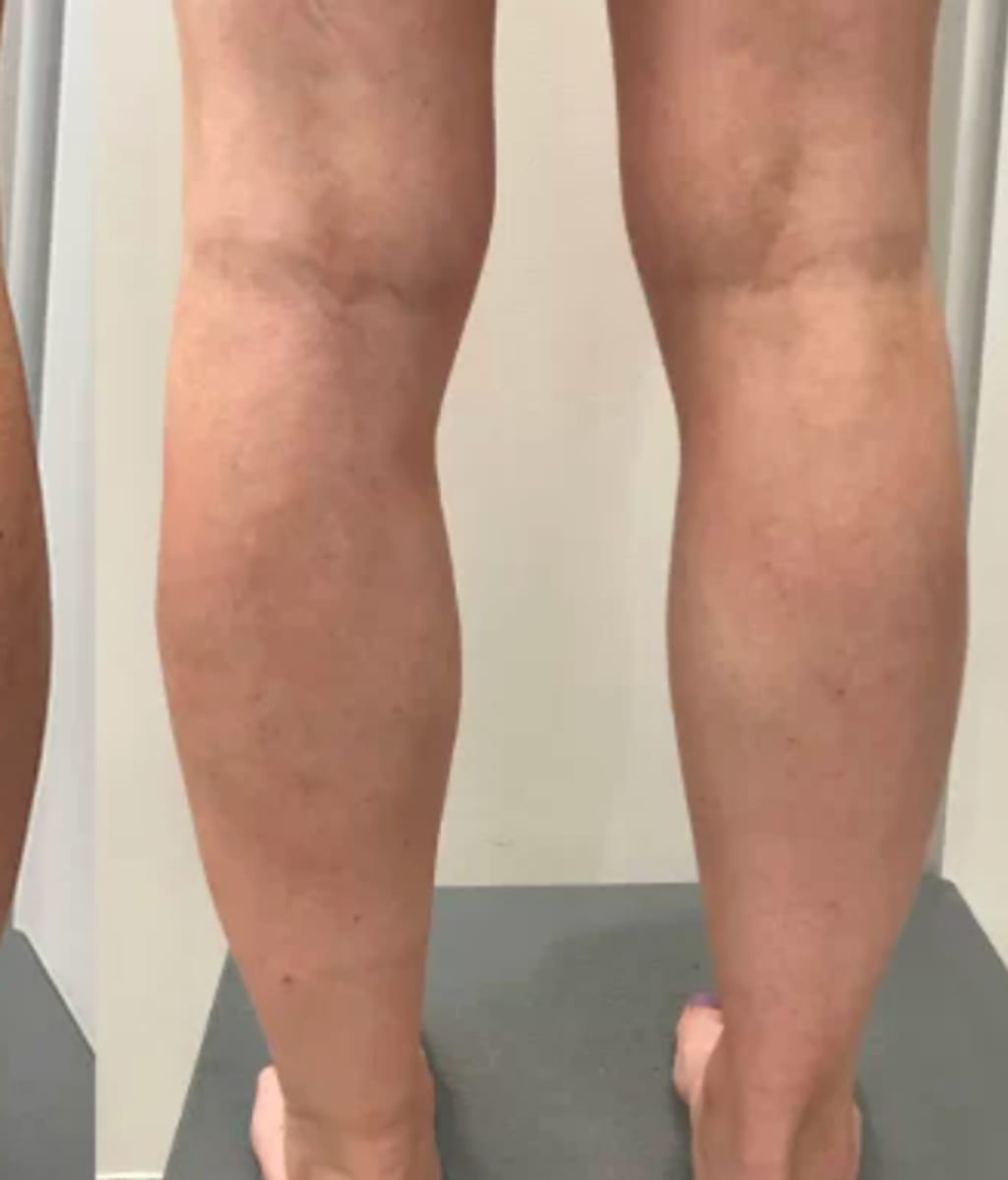 C-Varicose Vein Cream