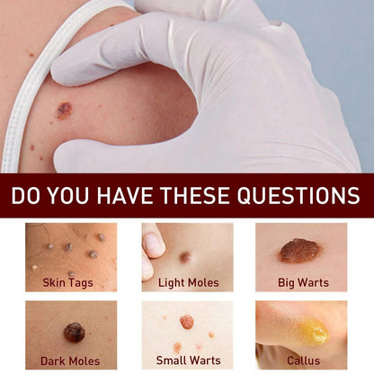 Best Sellers - Tags & Moles Remover——10 pcs (FREE SHIPPING)