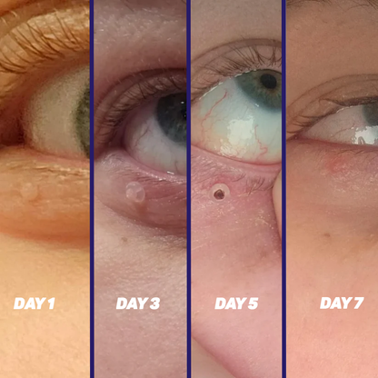 Skin Tag Removal Kit